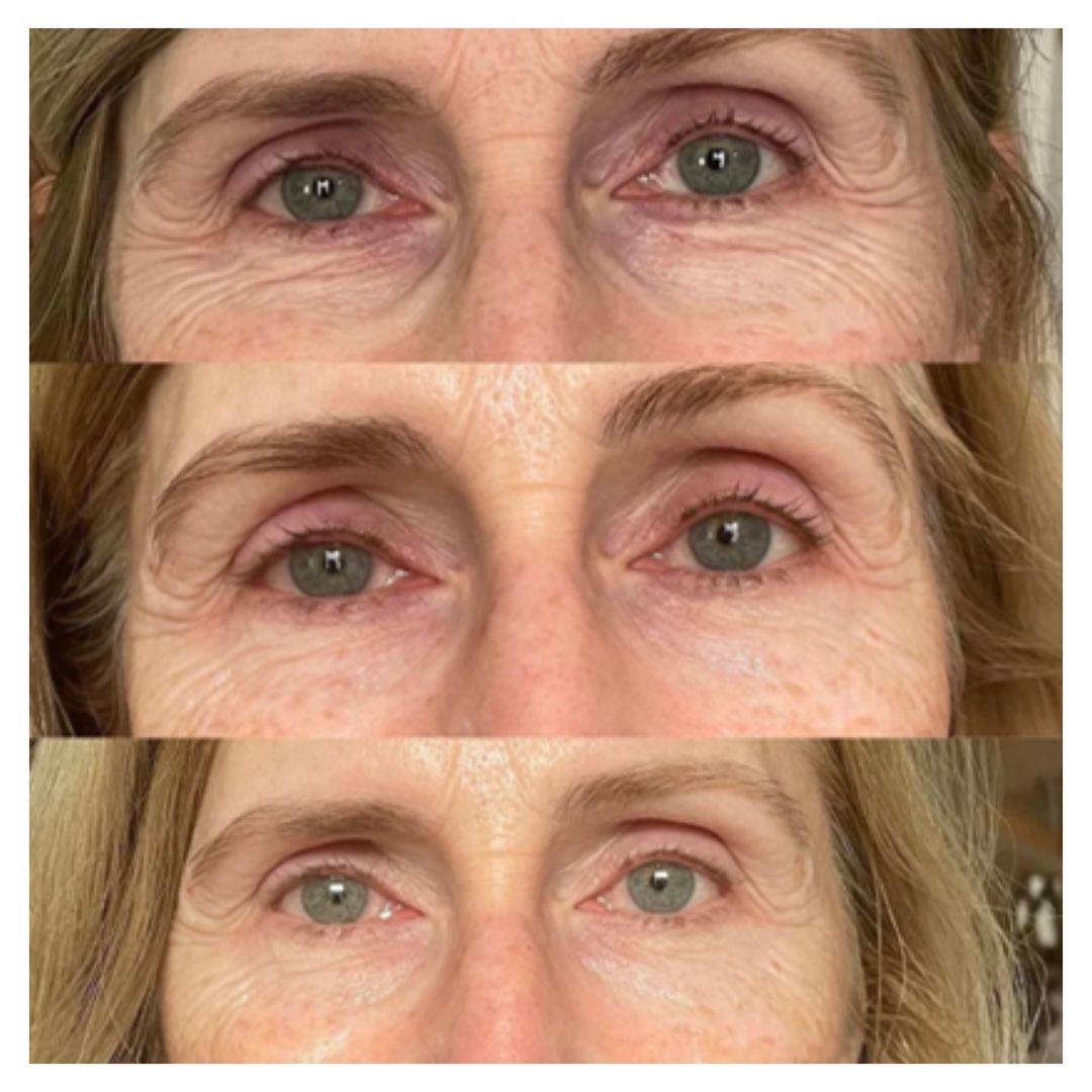 v-tox - treatment